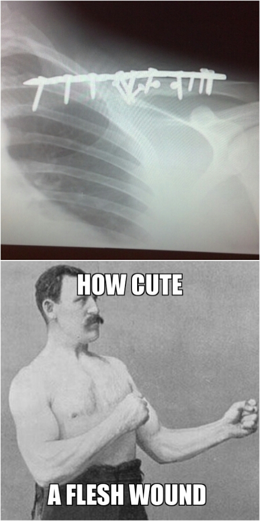 my actual X ray when i broke my collar bone in 6 places - meme